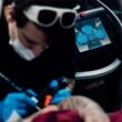 Como o laser atua na remoção de tatuagens?